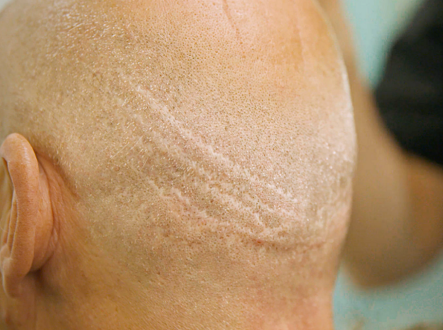 Hair transplantation scars and burn wounds